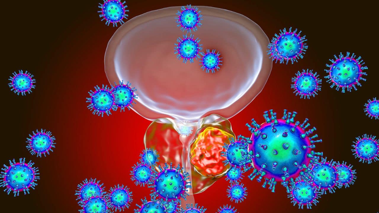 Are symptoms always present? Not really. A urinary tract infection may encompass asymptomatic bacteriuria (ASB), or it can have symptoms under cystitis, inflammation of the bladder, prostatitis, inflammation of the prostate, and pyelonephritis, infection of the kidney