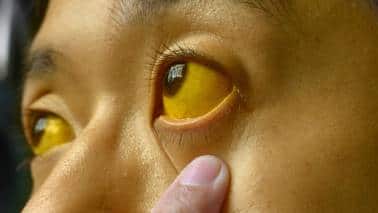 When Cancer Spreads: Jaundice, Ascites  If the cancer has spread to other organs, like the liver, yellowish discolouration of the skin and the eyes (jaundice) may become prominent. Collection of fluid in the abdominal cavity can make the abdomen distended. About 15% of people with stomach cancer may also have blood while vomiting and also blood in stools.