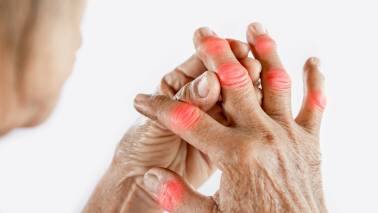 What’s behind CKD Chronic kidney disease can occur due to various causes, including diabetes mellitus (diabetic nephropathy), systemic lupus erythematosus (SLE), diseases that affect the joints like gout, and tumours. It can also be a consequence of accelerated hypertension and infectious diseases like tuberculosis.