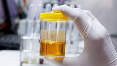 Diagnosis and Management Urinalysis plays a major role in the diagnosis of chronic kidney disease. The laboratory investigation may reveal blood, red cell casts, and even glucose in urine. Serum urea and creatinine are just as important. Radiological aids like ultrasounds and CT scans can help reveal the cause. Protein restriction is recommended.