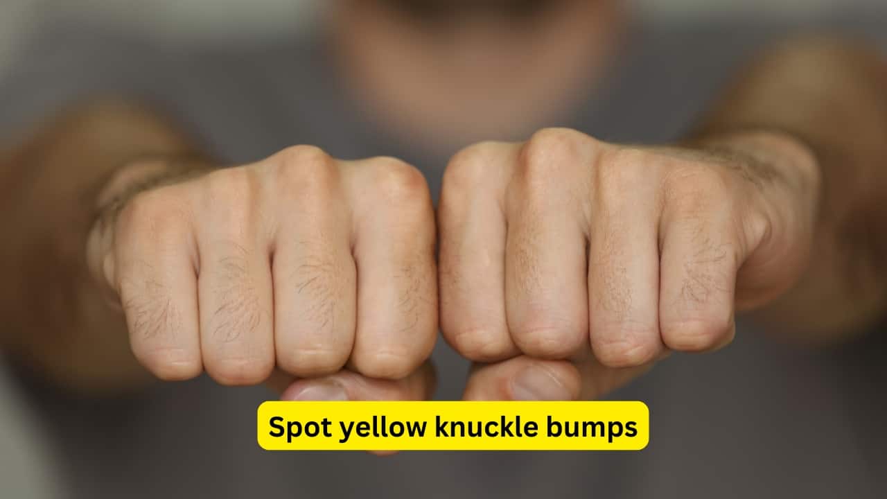 Spot yellow knuckle bumps If you’ve noticed firm, yellowish lumps on your knuckles, it’s not just dry skin. These are called xanthomas. They may mean high cholesterol. They also signal diabetes or liver problems. It is important to get a blood test in order to understand the issue. Consult a general practitioner (GP).
