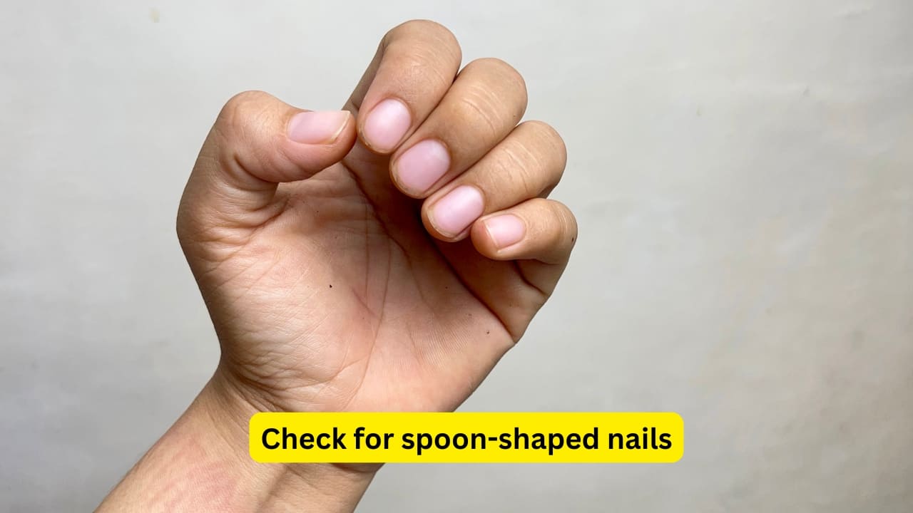 Check for spoon-shaped nails If your nails look scooped and water pools in the centre, it maybe a cause of concern. It is called koilonychia. It often suggests iron deficiency and may also signal thyroid issues. Low iron makes you tired. For proper diagnosis get a blood test done.