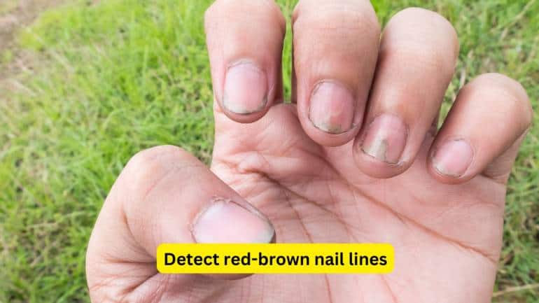 Detect red-brown nail lines Vertical red or brown lines under your nails should not be ignored. They might be splinter haemorrhages, linked to conditions like psoriasis or even heart infections. In rare cases, they signal skin cancer. If you notice these lines, book an appointment with your doctor or dermatologist.