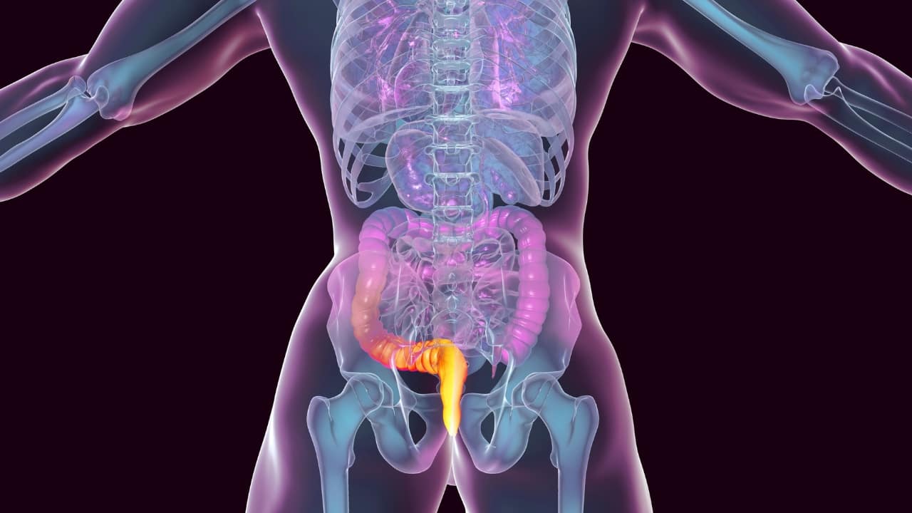 The Origin and Meaning of Haemorrhoids Etymologically, haemorrhoids, also called piles, means bleed (haima) and flowering (rhoos). It involves the downward sliding of the aggregation of blood vessels, muscles and connective tissue (anal cushion) because of excessive pressure or straining. Vascular type of piles is seen in the young, while mucosal type is common in older populations.