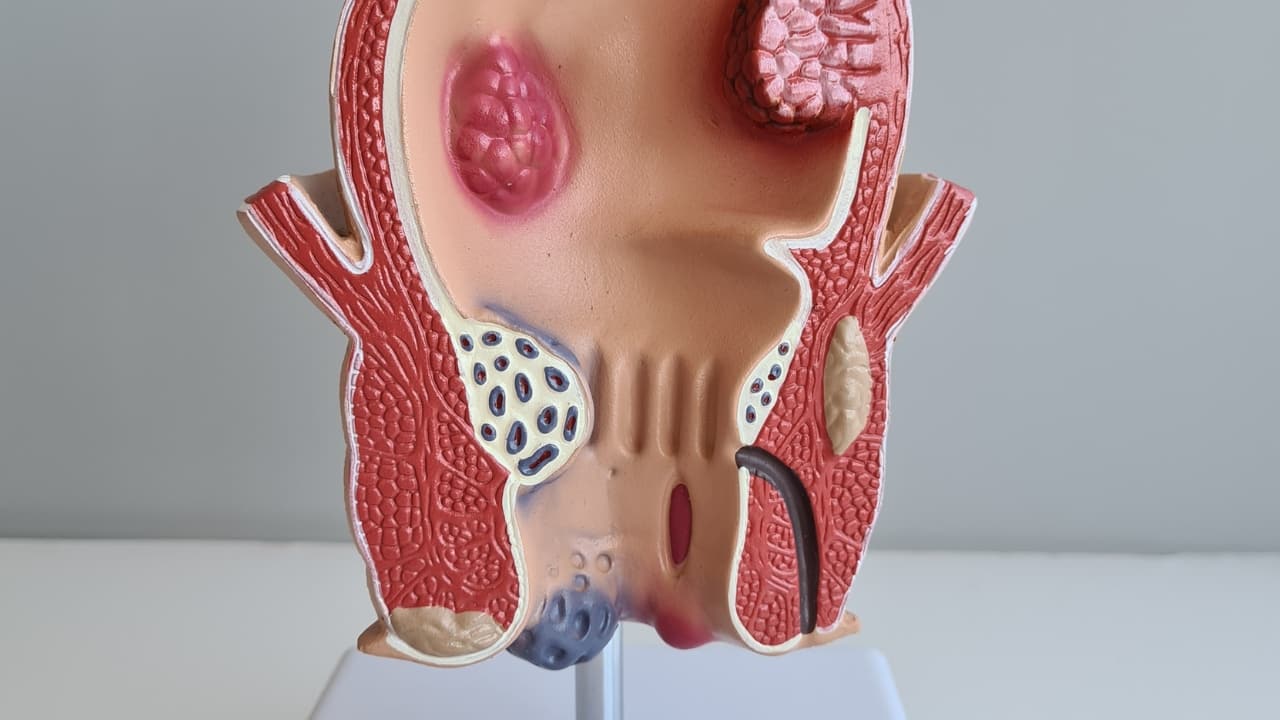 Potential Complications If Left Untreated If not treated on time, piles can have numerous complications. Some of those complications include ulceration in the anal area, gangrene (dead tissue due to loss of blood supply), fibrosis, suppuration and even thrombosis. In case of thrombosis, the piles begin tomapoesr dark purple or black, and become solid and tender.