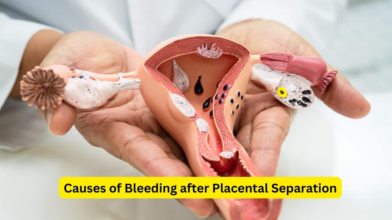 What is Postpartum Hemorrhage (Image: Canva)