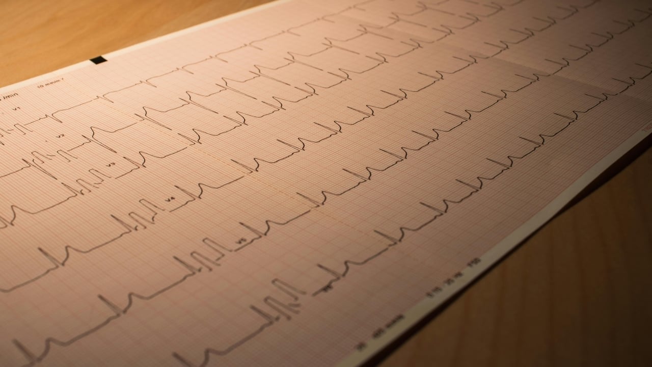 Protect Your Heart: Ditch These Habits to Lower Cholesterol and Reduce Stroke Risk