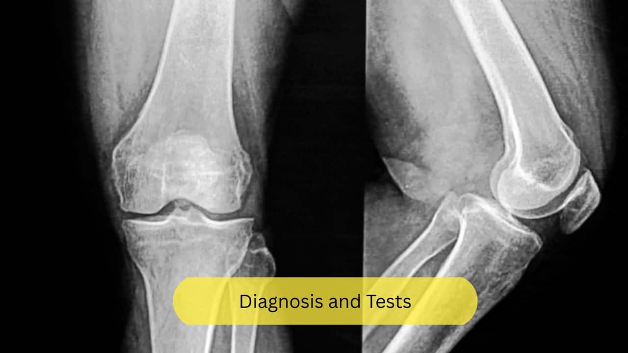 Diagnosis and Tests A plain X-ray is useful in identifying a fracture, and a CT or an MRI may help detect the same. However, radiography may not be able to adequately detect this disease in its early stages. Bone Mineral Density measures the mineral content of bones like calcium, potassium, manganese, and other minerals. This can aid in diagnosis. (Image: Canva)