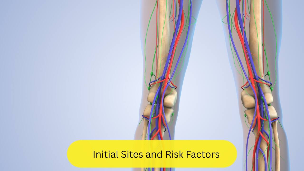 Initial Sites and Risk Factors More often than not, it begins in the lower limbs (first in one then in the other). Hormonal influence, familial nature, and hypersensitivity to cigarettes are probable causes for the development of Buerger’s disease. People who have frequent feet injuries and poor hygiene are also more susceptible.(Image: Canva)    