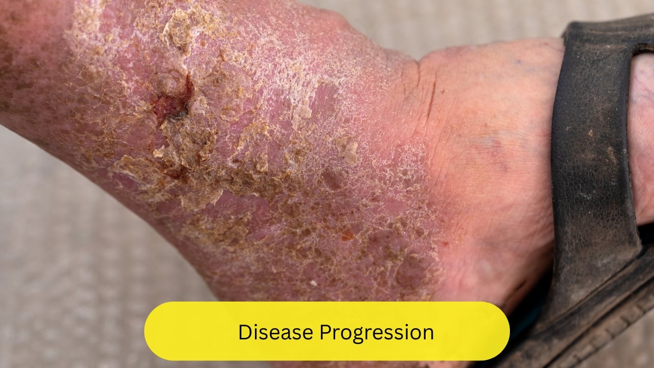 Disease Progression If the affected individual does not stop smoking, the disease progresses into the collaterals as well, thus leading to decompensatory peripheral vascular diseases. The limb eventually becomes devoid of oxygen, thus leading to ulceration and death of the tissues, that is, gangrene.(Image: Canva)