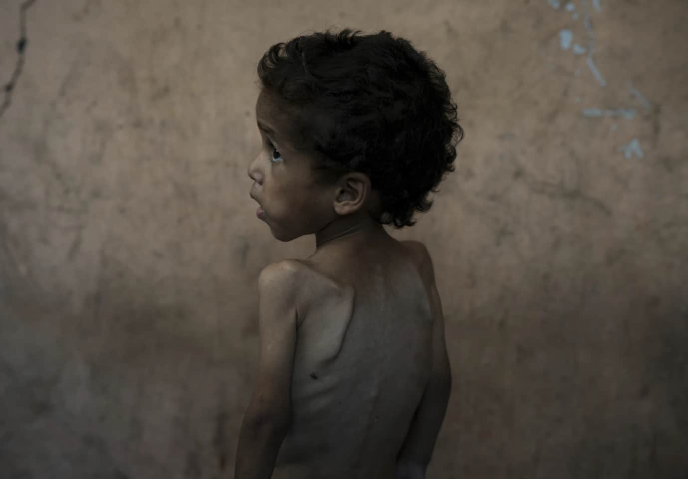 Two-year-old Yazan Abu Ful stands shirtless in his Gaza City home, affected by malnutrition amid the ongoing crisis. (Image: AP) 