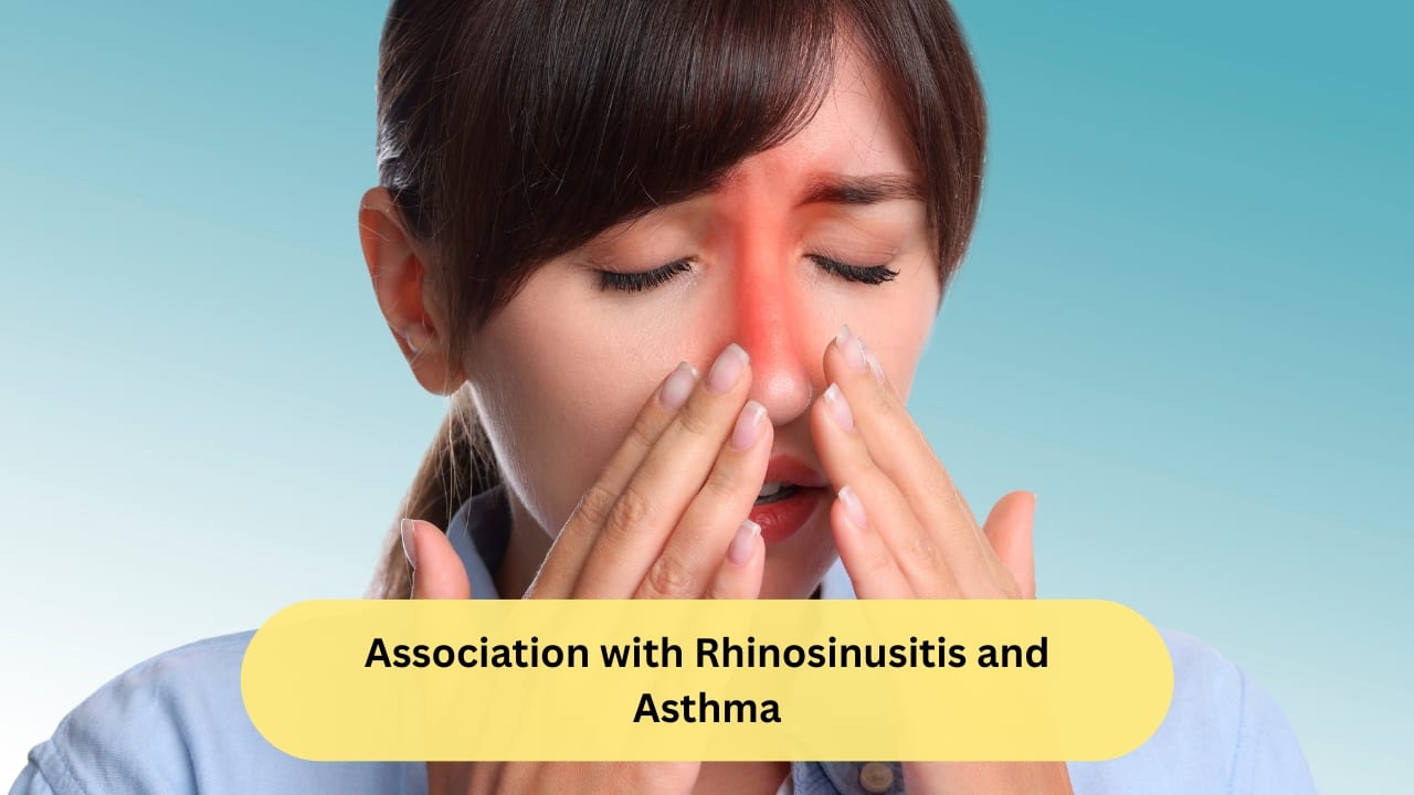 Association with Rhinosinusitis and Asthma People who have had long-term rhinosinusitis (inflammation of the air-filled cavities) are likely to develop nasal polyps as well. Alongside, about seven percent of people with bronchial asthma (either atopic or non-atopic type) also have an increased risk of nasal polyps.(Image: Canva)