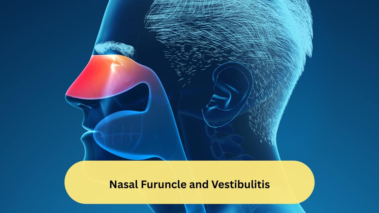 Nasal Furuncle and Vestibulitis A nasal furuncle refers to a painful infection of the hair follicle in the area just inside the nostrils (known as the nasal vestibule). Also called a nasal boil, it can lead to the formation of nasal polyp on one side of the nose. Inflammation of the vestibule is also a cause of this condition.(Image: Canva)