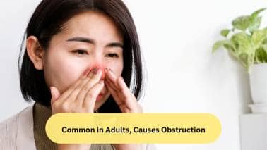 Common in Adults, Causes Obstruction The presence of multiple polypi can be seen at any age, but is more commonly observed in adults. Due to nasal polypi, the nose may feel stuffy, which can result in total nasal obstruction. Anosmia, or loss of sense of smell, can also be a presenting feature in this condition.(Image: Canva)