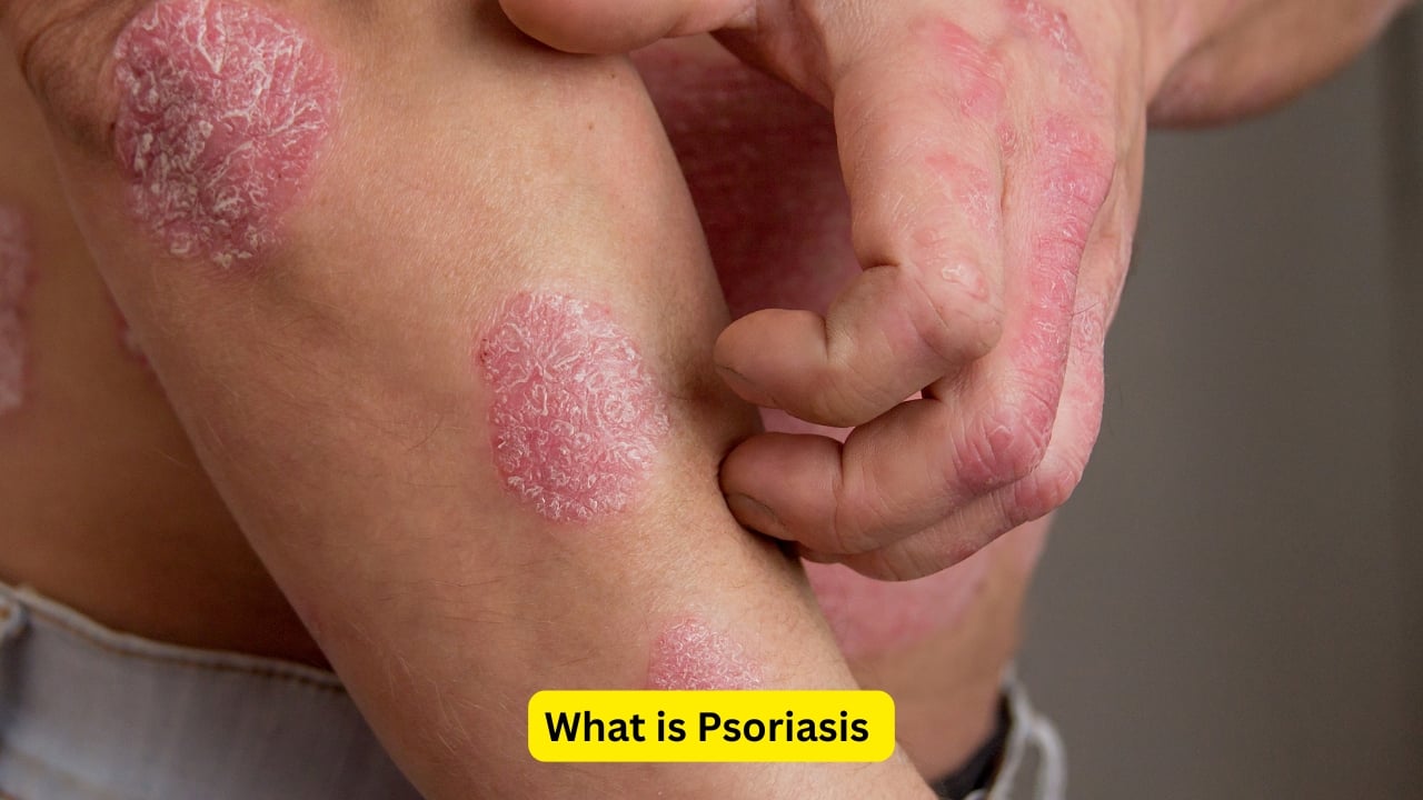 10 smart ways to manage psoriasis flare-ups: Prevention, treatment and more