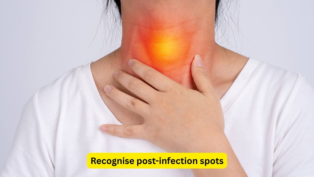 Recognise post-infection spots A certain type of psoriasis known as guttate psoriasis occurs after a throat or respiratory infection. The condition presents as tiny red spots that are mainly seen on the torso or limbs. This type often affects young people or children. Early treatment involving topical or light therapies during the initial phase usually results in faster recovery.(Image: Canva) 