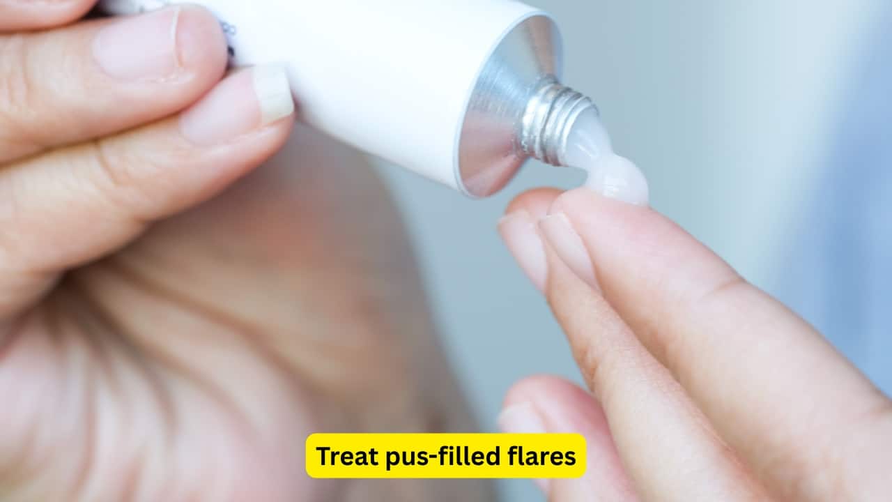 Treat pus-filled flares The skin condition of pustular psoriasis produces inflamed red skin which contains pus-filled bumps that commonly develop on the hands and feet. The onset of flare-ups often occurs after a stressful episode, along with certain drugs and microbial infections. Topical steroids and systemic therapies may stop the inflammation and prevent potential complications.(Image: Canva) 
