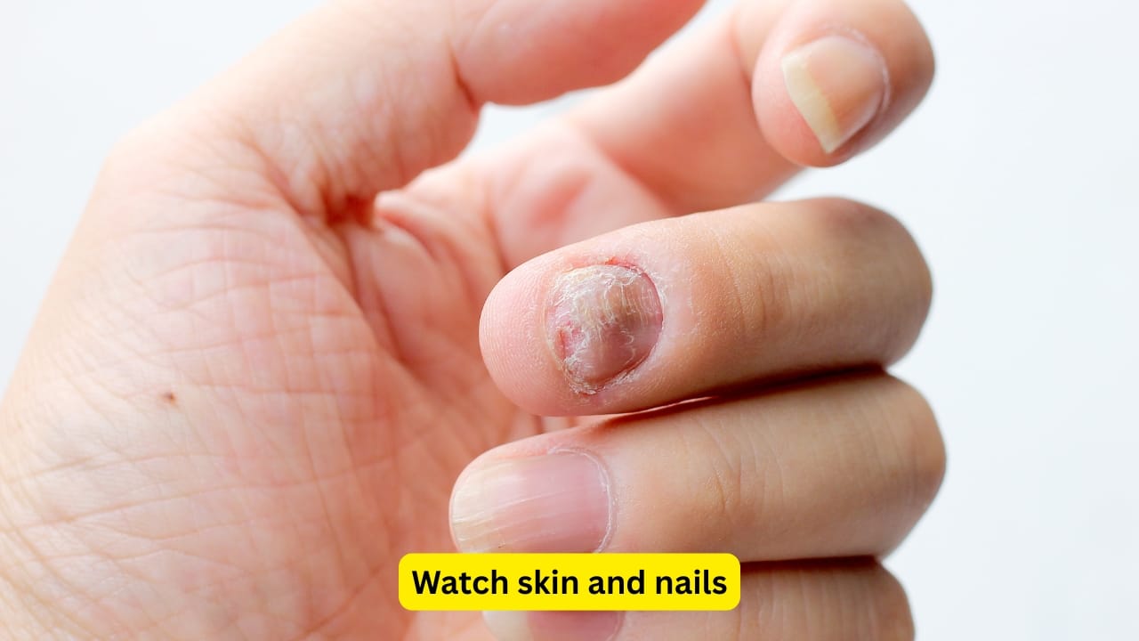 Watch skin and nails People who have psoriasis may often experience dry skin that cracks along with nails that become pitted and develop ridges. Itching sensations and pain are also common, and sometimes bleeding may also occur. The presence of nail psoriasis can disrupt normal activities and might be an indicator of joint involvement.(Image: Canva)