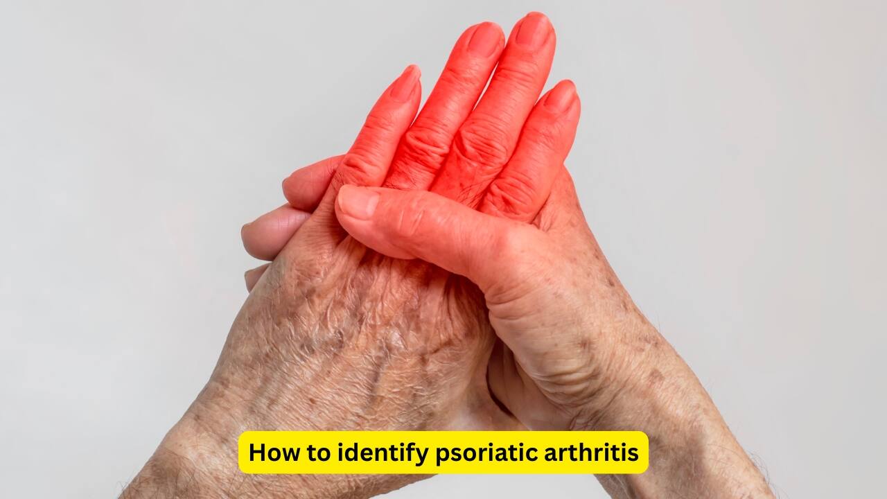 How to identify psoriatic arthritis About 30% of people with psoriasis develop psoriatic arthritis, which causes joint pain, stiffness and swelling, especially in the fingers. Failing to treat these symptoms can allow permanent damage to the joints. Your doctor should be consulted right away if you experience joint pain because treatment with disease-modifying drugs and physiotherapy can help in this condition.(Image: Canva)
