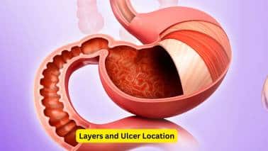 Layers and Ulcer Location The duodenum is made up of four layers, the mucosa, submucosa, muscularis and serosa. A break in the continuity of the lining of the mucosa, which may also involve the submucosa is known as a peptic ulcer. Most of the first portion of the duodenum is commonly affected by a peptic ulcer (more than the stomach).(Image: Canva)