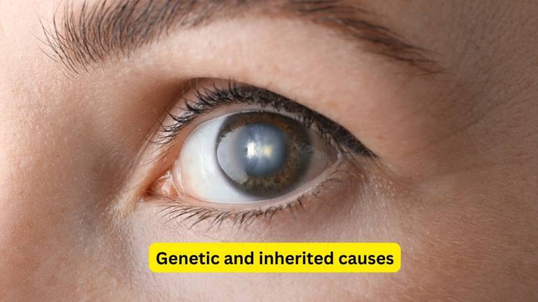 Cataract Causes, Risk Factors, Symptoms and Management (Images: Canva)