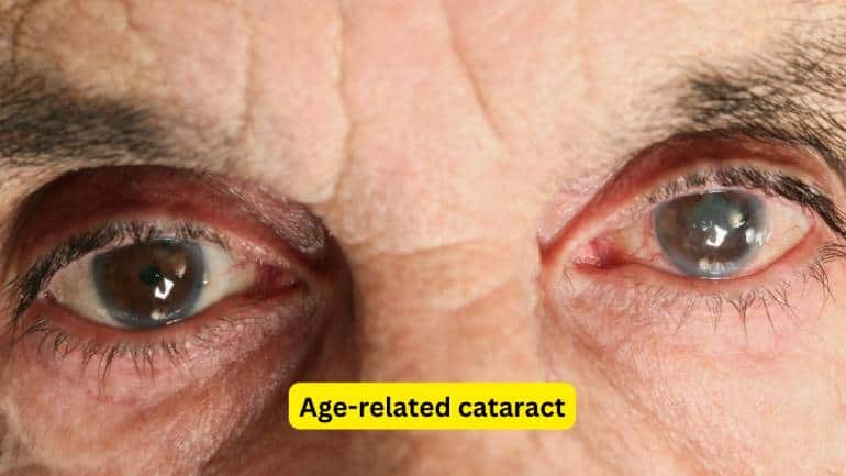 Cataract Causes, Risk Factors, Symptoms and Management (Images: Canva)