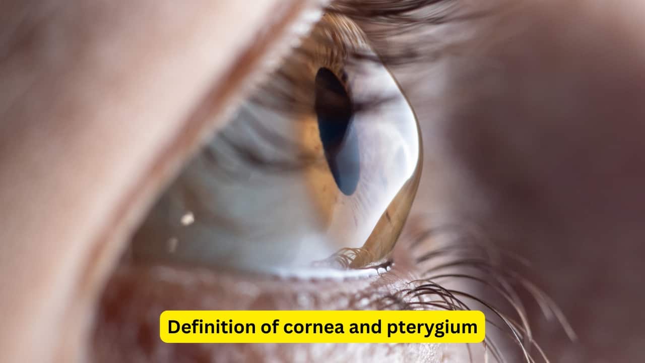 Definition of cornea and pterygium The cornea is the clear part, present in the front surface of the eye. It is dome-shaped, and covers the iris and the pupil. A pterygium refers to a wing-shaped fold of the conjunctiva which encroaches upon the cornea. It may develop on either side within the eye.(Image: Canva) Definition of cornea and pterygium The cornea is the clear part, present in the front surface of the eye. It is dome-shaped, and covers the iris and the pupil. A pterygium refers to a wing-shaped fold of the conjunctiva which encroaches upon the cornea. It may develop on either side within the eye.(Image: Canva)