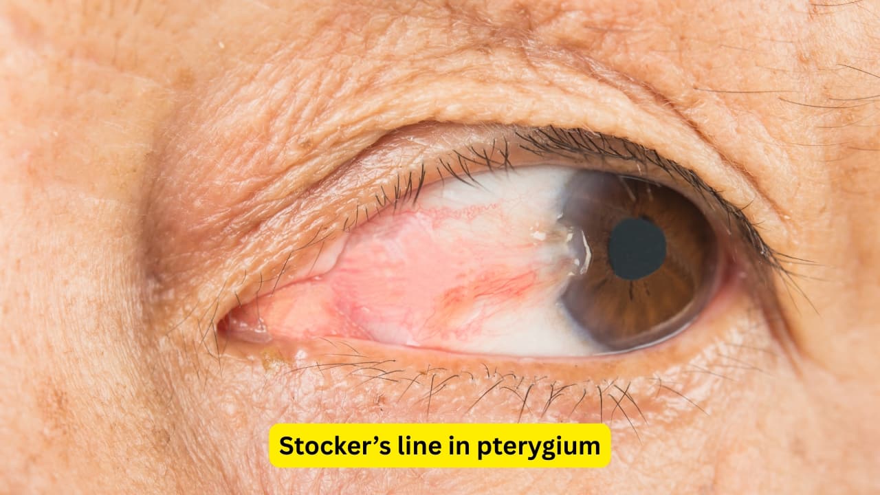 Stocker’s line in pterygium Sometimes, iron may get deposited in the epithelium of the cornea, in front of the head of the pterygium (the leading part). This is known as the stocker’s line. A pterygium may be progressive or regressive. A progressive pterygium is often thick and fleshy, and may have blood supply as well.(Image: Canva) Stocker’s line in pterygium Sometimes, iron may get deposited in the epithelium of the cornea, in front of the head of the pterygium (the leading part). This is known as the stocker’s line. A pterygium may be progressive or regressive. A progressive pterygium is often thick and fleshy, and may have blood supply as well.(Image: Canva)