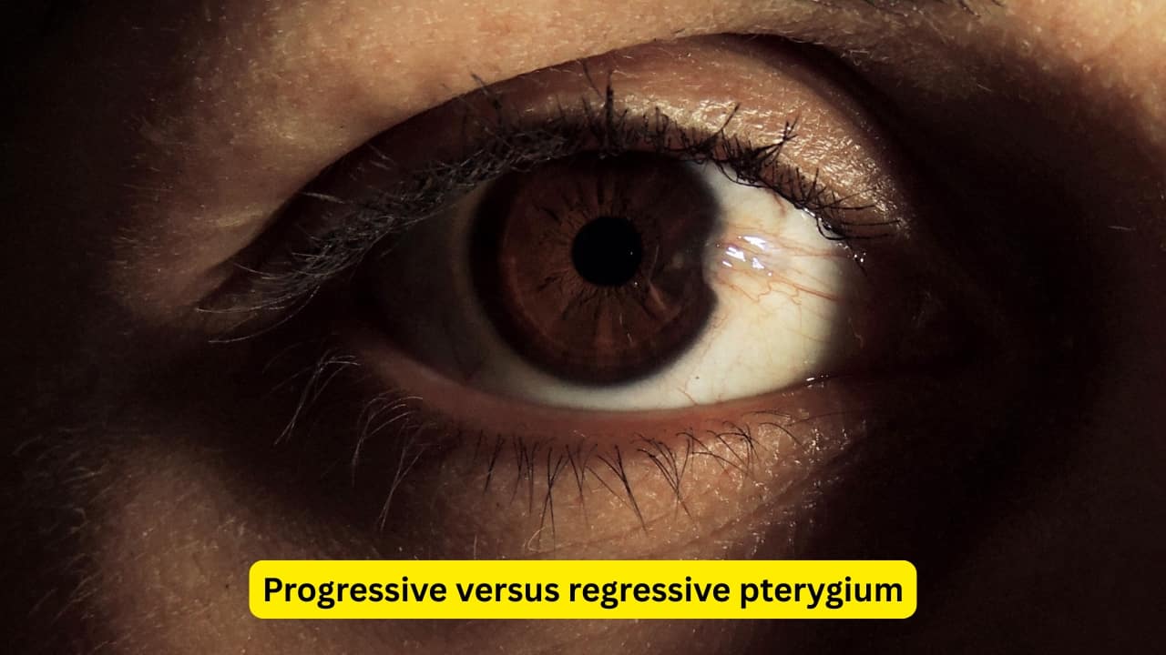 Progressive versus regressive pterygium On the other hand, a regressive pterygium is thin and atrophy, and does not have a lot of vasculature. In the early stages, a pterygium may not show any symptoms. Cosmetic reasons may urge people to visit the ophthalmologist, especially in the early stages of its development.(Image: Canva) Progressive versus regressive pterygium On the other hand, a regressive pterygium is thin and atrophy, and does not have a lot of vasculature. In the early stages, a pterygium may not show any symptoms. Cosmetic reasons may urge people to visit the ophthalmologist, especially in the early stages of its development.(Image: Canva)