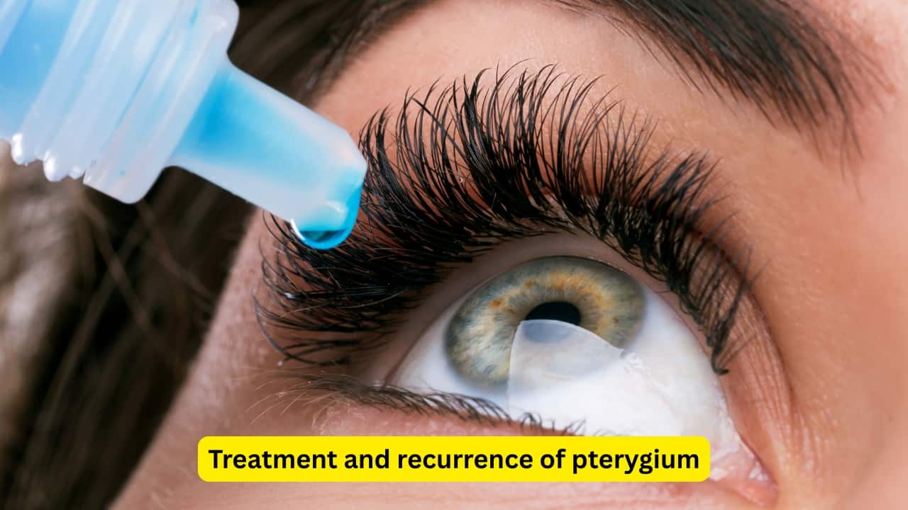 Treatment and recurrence of pterygium The treatment is usually surgical, and surgery may be performed either for cosmetic reasons, or because of the visual disturbances. Recurrence is seen in almost thirty to fifty percent of pterygium cases after surgery. Post-operative use of drugs like mitomycin may be recommended by the healthcare provider.(Image: Canva) Disclaimer: This article, including health and fitness advice, only provides generic information. Don’t treat it as a substitute for qualified medical opinion. Always consult a specialist for specific health diagnosis Treatment and recurrence of pterygium The treatment is usually surgical, and surgery may be performed either for cosmetic reasons, or because of the visual disturbances. Recurrence is seen in almost thirty to fifty percent of pterygium cases after surgery. Post-operative use of drugs like mitomycin may be recommended by the healthcare provider.(Image: Canva) Disclaimer: This article, including health and fitness advice, only provides generic information. Don’t treat it as a substitute for qualified medical opinion. Always consult a specialist for specific health diagnosis
