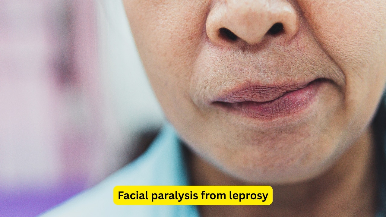 Facial paralysis from leprosy Leprosy can also lead to facial paralysis. Leprosy is caused by a microorganism called Mycobacterium leprae, which can often damage nerves. The severity may vary from mild weakness to complete paralysis of either one or both sides of the face. Leprosy may influence damage in the eyes as well.(Image : Canva)