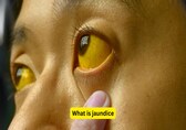 Tired with yellow eyes? 10 things to knows about jaundice: Causes, symptoms and management