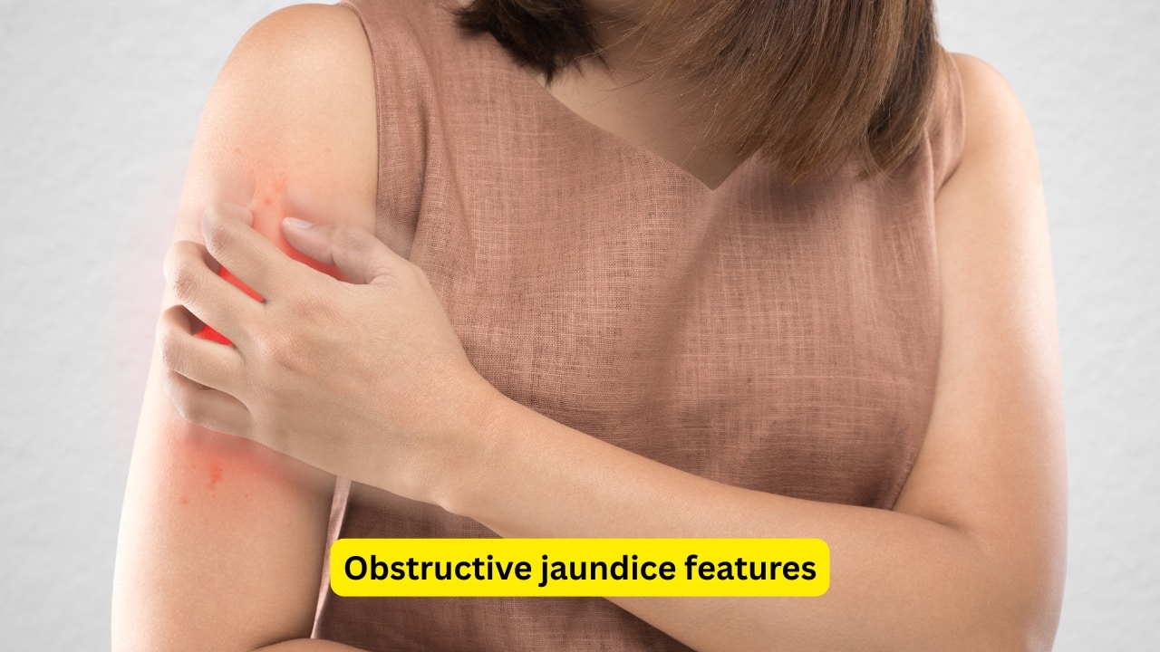 Obstructive jaundice features Obstructive jaundice is also called surgical jaundice, as the cause most often requires some surgical intervention. The affected individual may experience intense itching all over the body, as the bile salts saponify the fat that is present around the nerve endings.(Image: Canva)