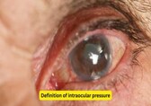 What is glaucoma and intraocular pressure? Understanding the disease, risks, and management