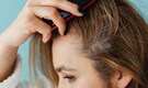 Is it just dandruff or scalp psoriasis? How to identify symptoms early, keep your hair healthy Is it just dandruff or scalp psoriasis? How to identify symptoms early, keep your hair healthy