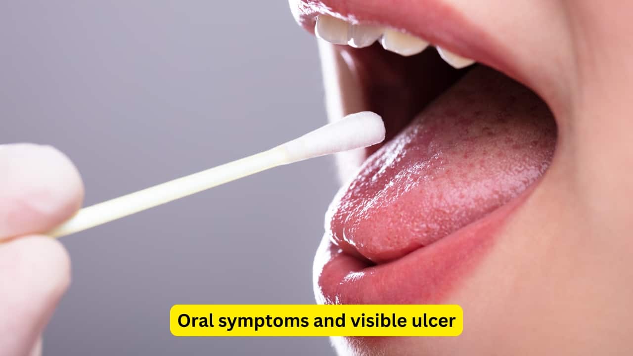 Oral symptoms and visible ulcer The affected individual can experience excessive salivation, and the saliva may sometimes be blood-stained. A difficulty in swallowing may also be a complaint due to fixation of the tongue. A visible ulcer can be observed in the anterior part of the tongue. However, the ulcer may bleed on touch.(Image: Canva)