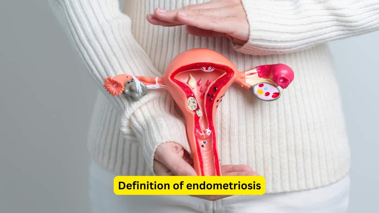 Definition of endometriosis The presence of a functioning endometrium (the glands along with the stroma) in places other than the uterine mucosa is known as endometriosis. Cyclic hormones can stimulate growth of such endometrial tissue, but continuous secretion of hormones may suppress it.(Image: Canva)