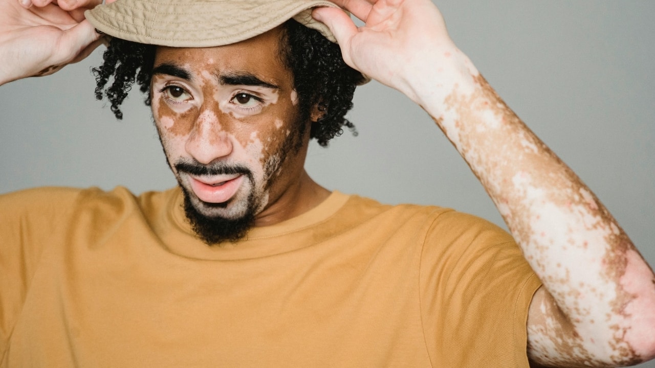 Psoriasis Awareness Month: Can diet influence psoriasis? What dermatologists recommend