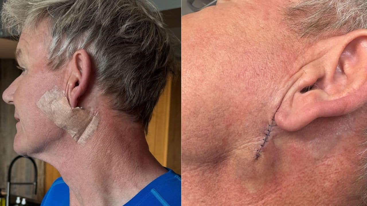 Chef Gordon Ramsay reveals undergoing surgery for skin cancer: "Don't forget your sunscreen"