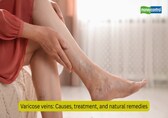 Varicose veins: Causes, treatment, and natural remedies to keep your legs healthy