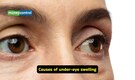 Dermatologist-approved home remedies and skincare tips to reduce swollen and puffy eyes
