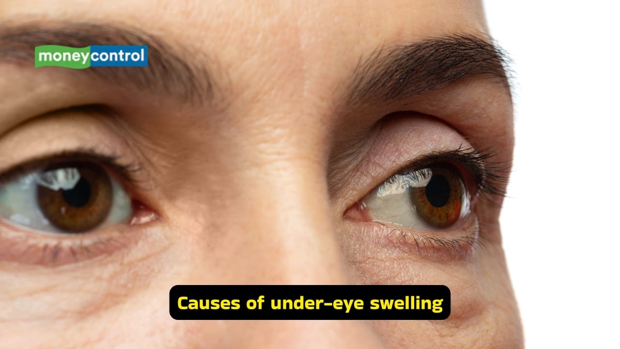 Dermatologist-approved home remedies and skincare tips to reduce swollen and puffy eyes Dermatologist-approved home remedies and skincare tips to reduce swollen and puffy eyes