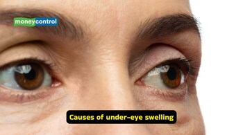 Causes of under-eye swelling: Fluid retention is one of the most common causes, often linked to high salt intake, dehydration, or sleeping in a flat position (Image: Canva)