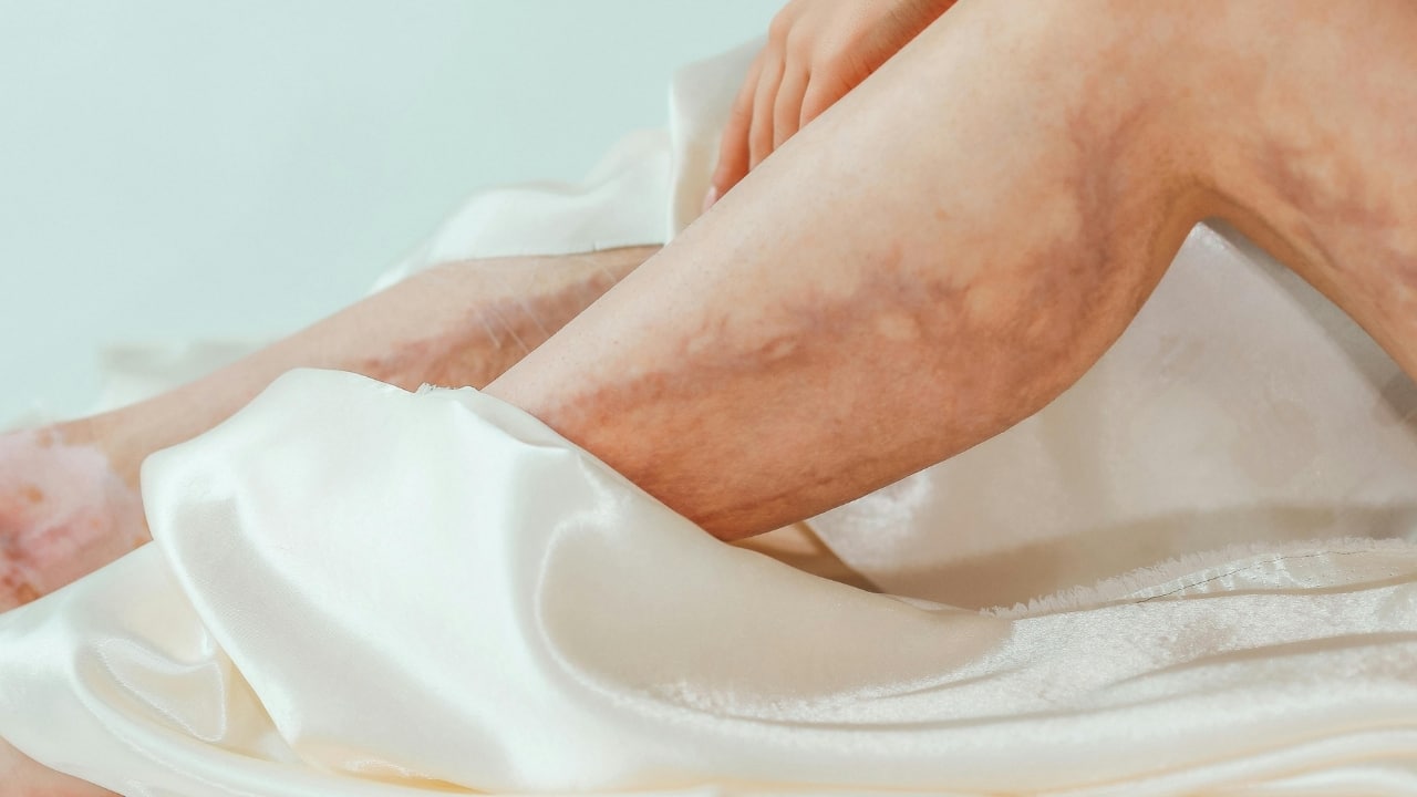 CVI in women: How hormones, pregnancy and age affect vein health