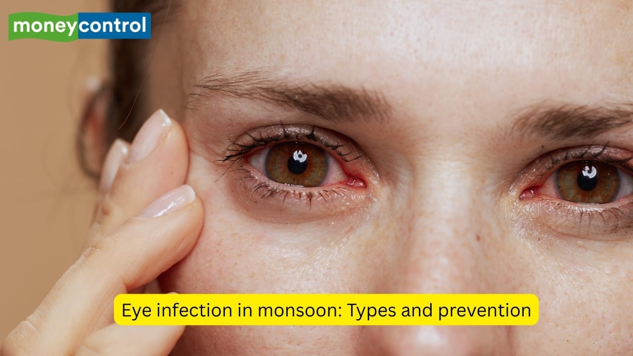 Eye infection in monsoon: Types of infections and tips for prevention