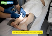 Would you break your legs to be taller? Inside the costly, painful limb-lengthening surgery trend