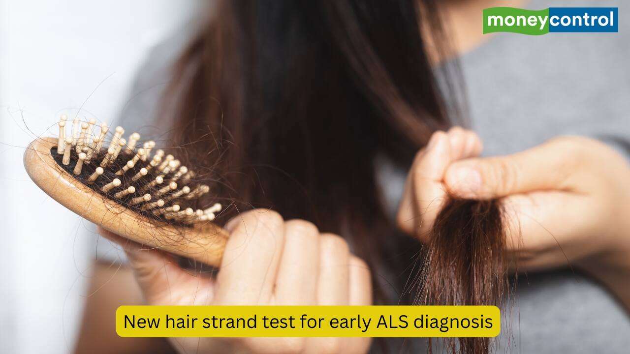 Researchers find a new simple hair strand test that shows promise of early ALS diagnosis