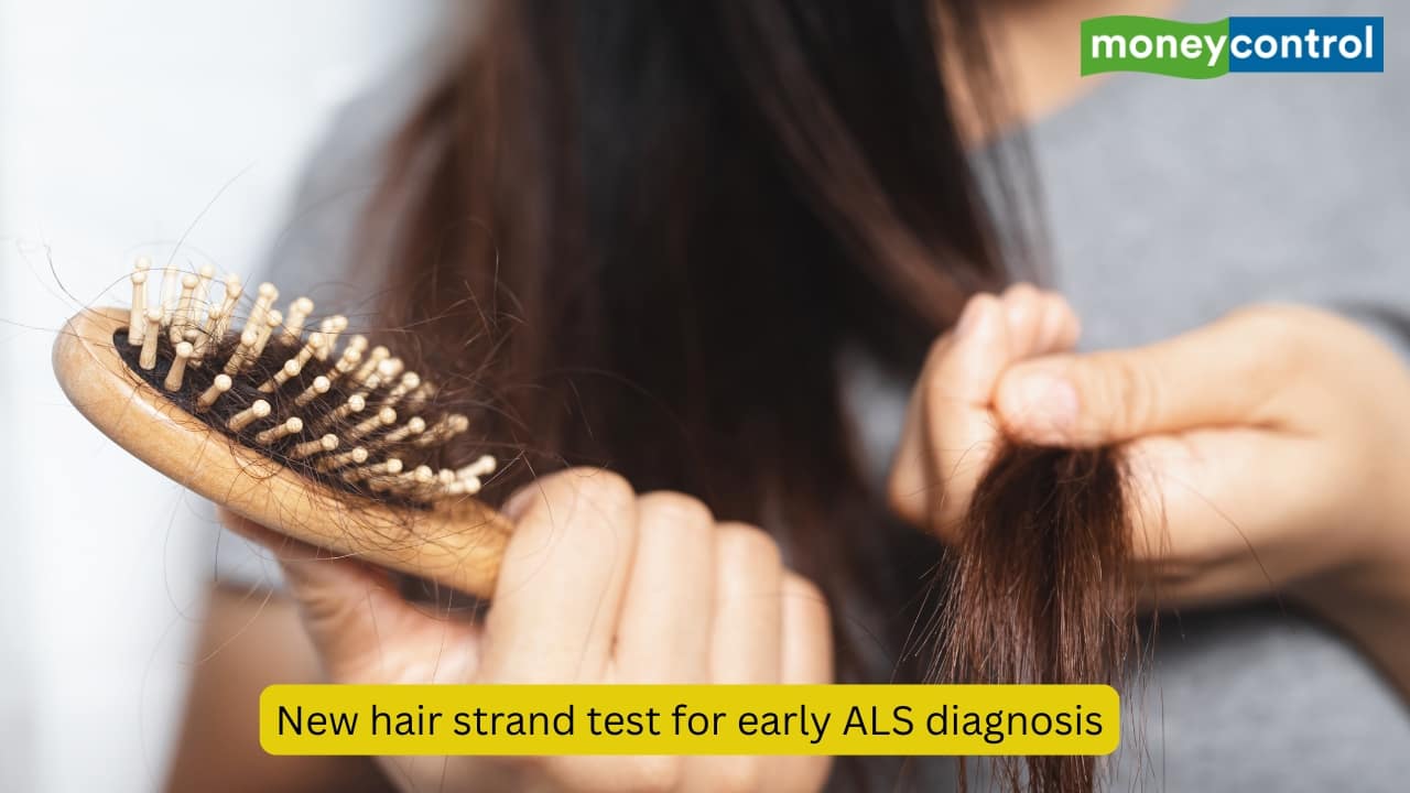 Researchers find a new simple hair strand test that shows promise of early ALS diagnosis