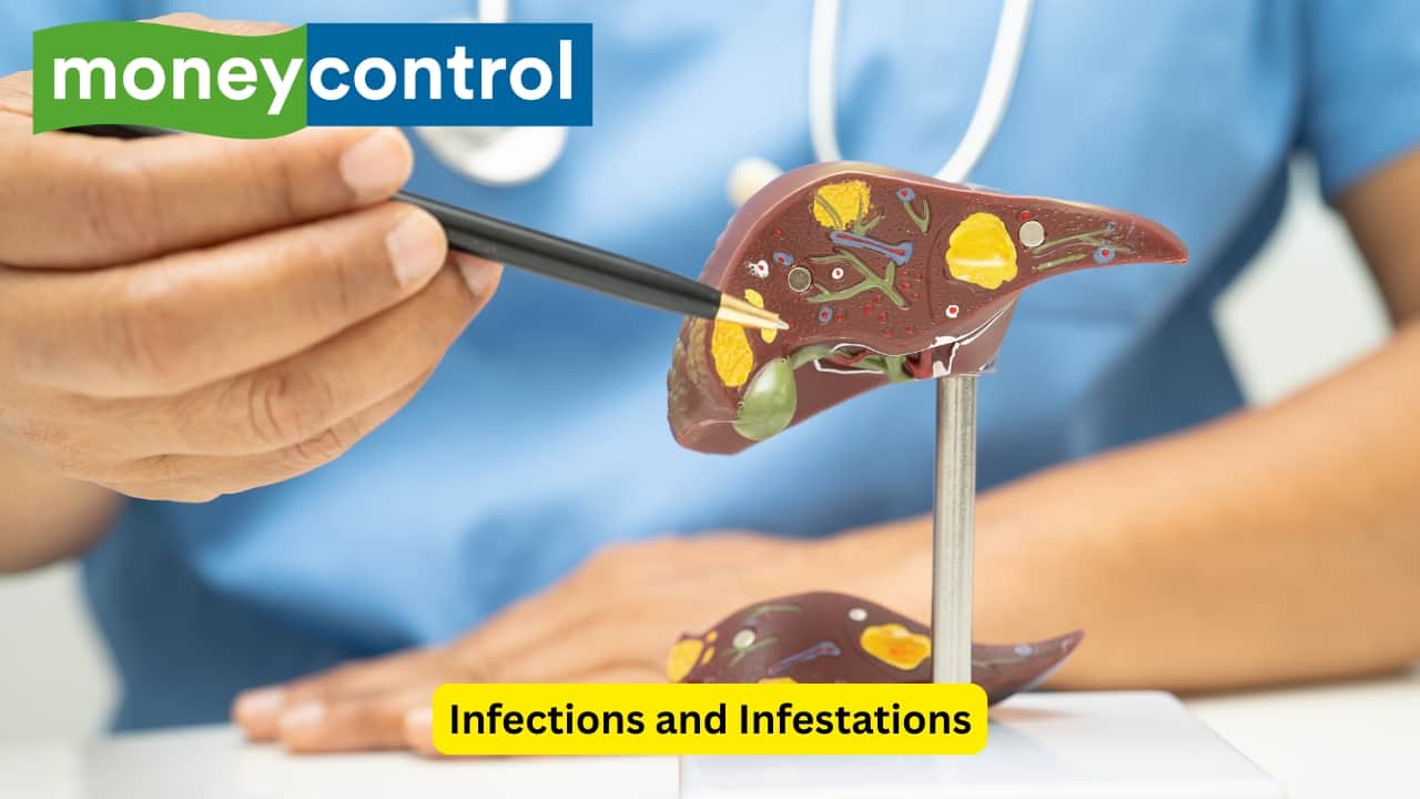 Infections and Infestations Infections and infestations by various bacteria like Escherichia coli and Salmonella can also lead to the formation of these stones. Parasites like Clonorchis and Ascaris lumbricoides (roundworm) are also etiological factors for cholelithiasis. Stasis of bile, like in pregnancy may also be a reason.(Image: Canva)