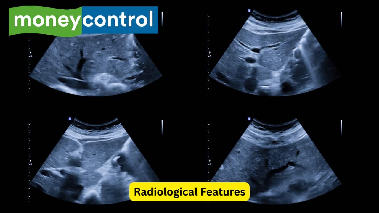 Radiological Features In some cases, the centre of the stone may contain radiolucent gas. SOme stones may either be triradiate or biradiate. Some stones may remain silent and asymptomatic, and are seen in ten percent of males and twenty percent of females. Other people may experience biliary colic, and the pain occurs within hours of a meal.(Image: Canva)